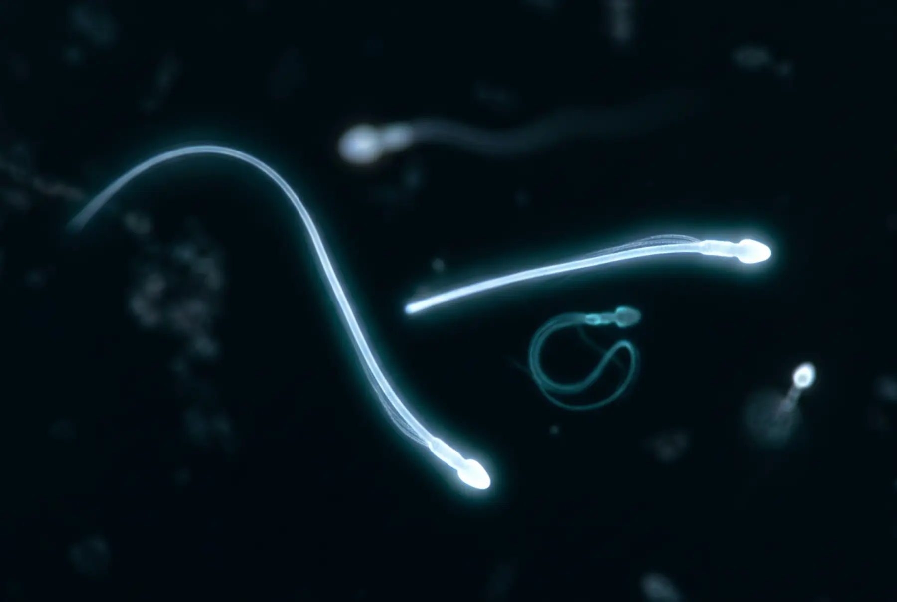 Informe de seminograma con diagnóstico de astenozoospermia y motilidad progresiva por debajo del 30%